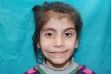 Doğuştan Yüz Felci Belirtileri ve Tedavisi